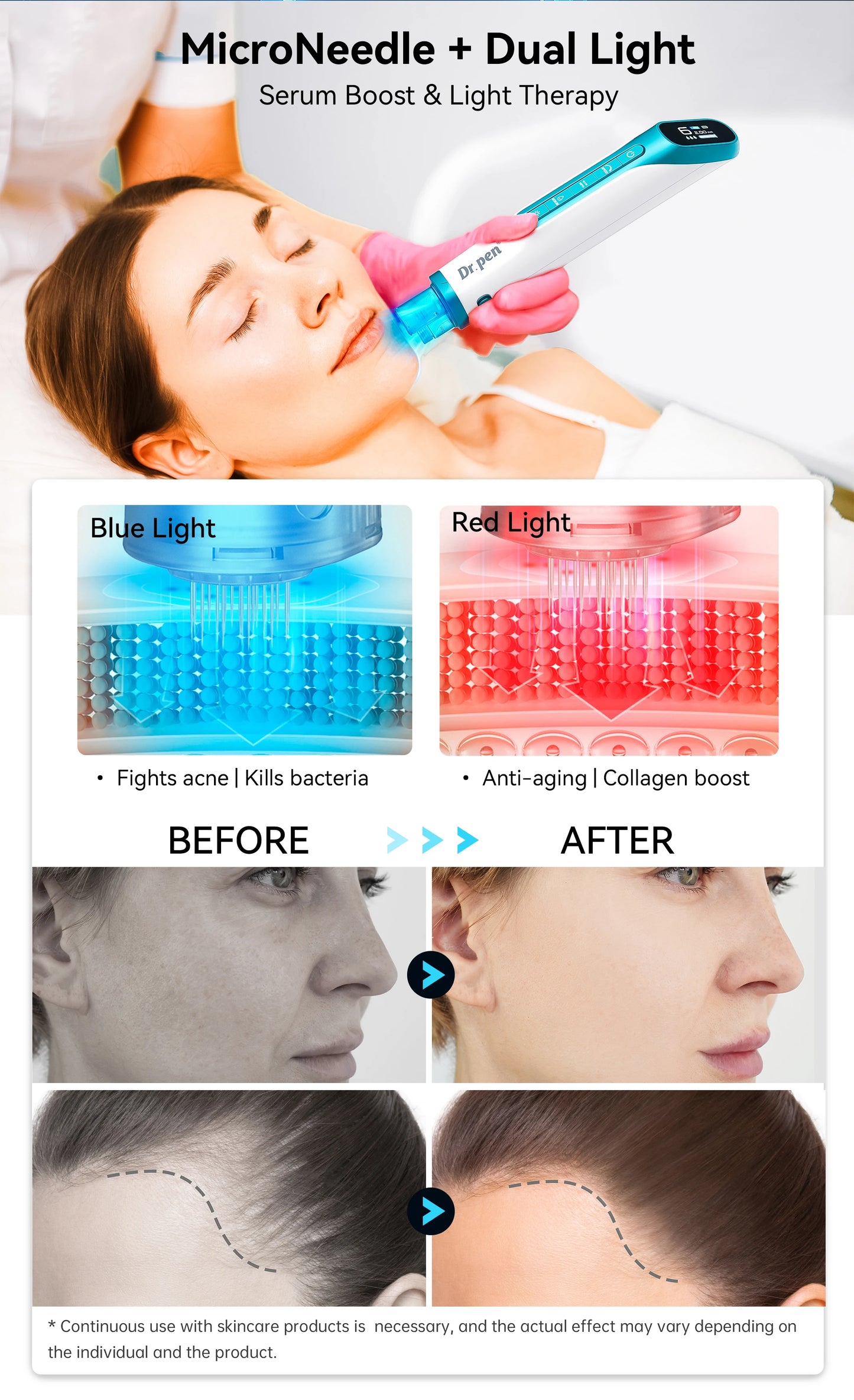 Dr. Pen H6 Derma Pen Advanced Serum Infusion Microneedling Pen with Light Therapy Needle length 0.25 MM