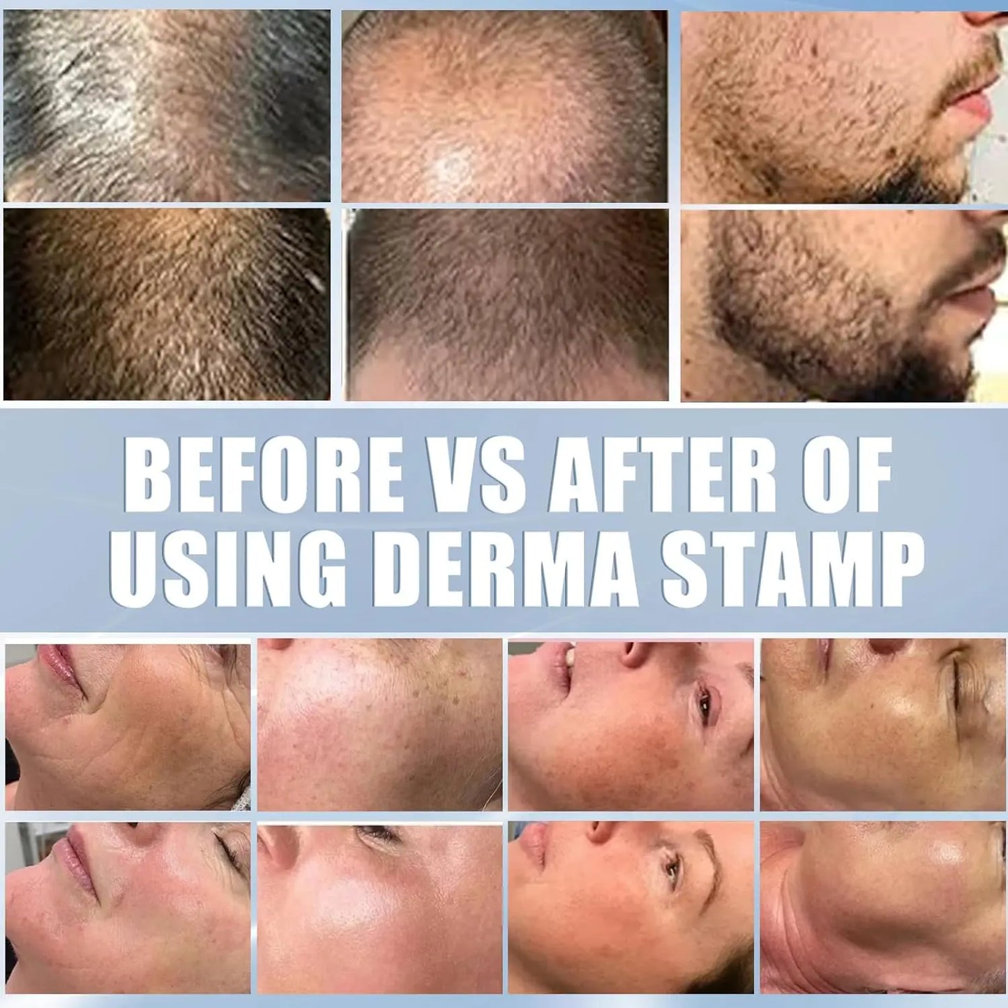 Derma Stamp Adjustable Microneedling With 140 pin Needles Face Body Care Hair Beard Growth 0.25 MM Needle length